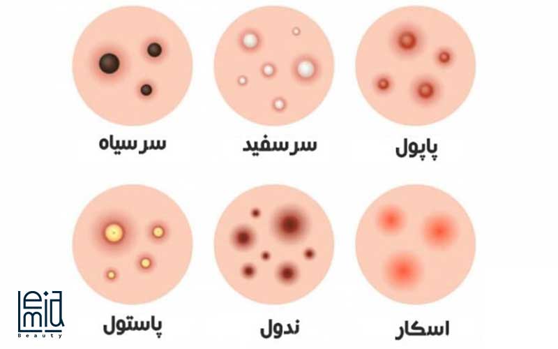 انواع-جوش-صورت-لمیاشاپ